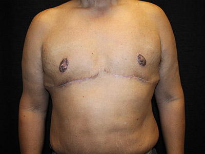 Patient #51914: Gynecomastia<br>with Reduction After Image
