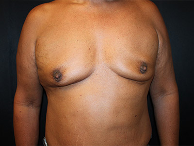 Patient #51914: Gynecomastia<br>with Reduction Before Image