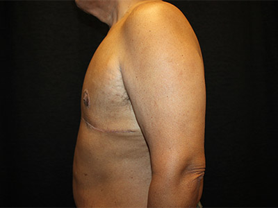 Patient #51914: Gynecomastia<br>with Reduction After Image