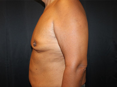 Patient #51914: Gynecomastia<br>with Reduction Before Image