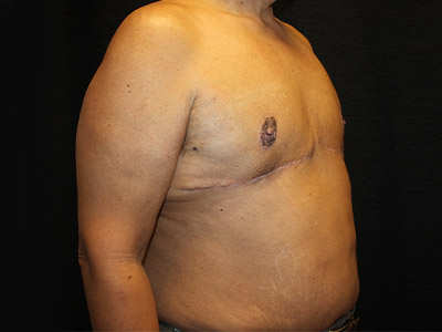 Patient #51914: Gynecomastia<br>with Reduction After Image