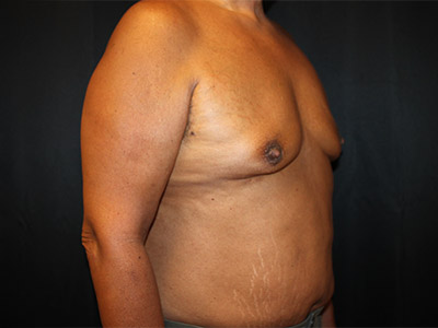 Patient #51914: Gynecomastia<br>with Reduction Before Image