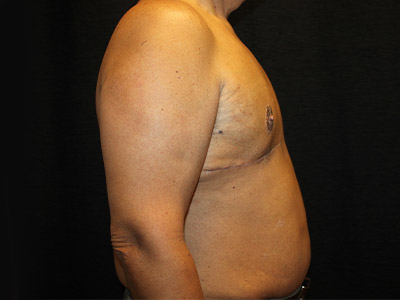 Patient #51914: Gynecomastia<br>with Reduction After Image