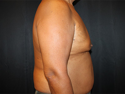 Patient #51914: Gynecomastia<br>with Reduction Before Image