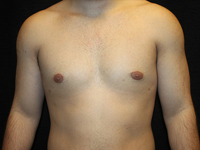 Patient #52197: Gynecomastia After Image