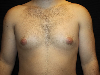 Patient #52197: Gynecomastia Before Image
