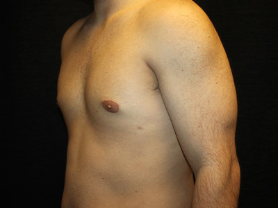 Patient #52197: Gynecomastia After Image