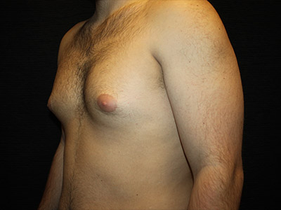 Patient #52197: Gynecomastia Before Image