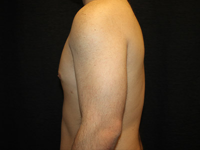 Patient #52197: Gynecomastia After Image