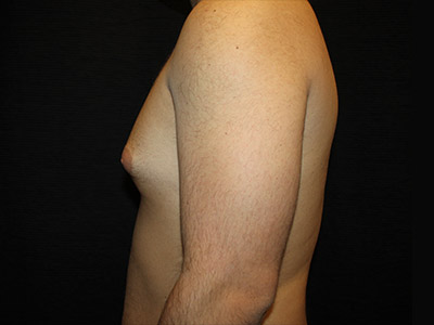 Patient #52197: Gynecomastia Before Image