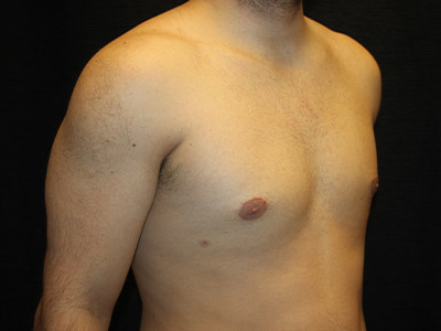 Patient #52197: Gynecomastia After Image