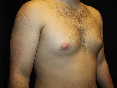Patient #52197: Gynecomastia Before Image