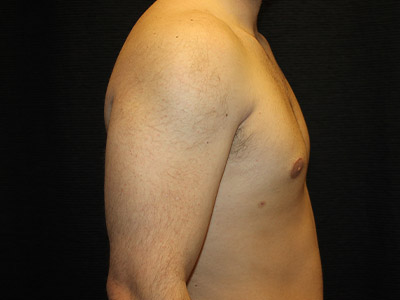 Patient #52197: Gynecomastia After Image