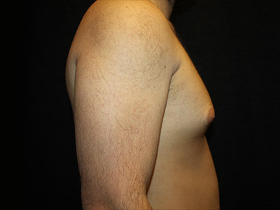 Patient #52197: Gynecomastia Before Image