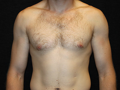 Patient #59775: Gynecomastia After Image