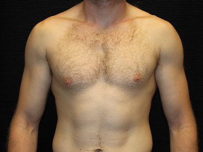 Patient #59775: Gynecomastia Before Image