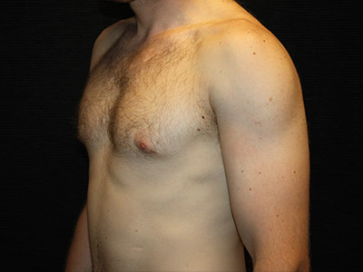Patient #59775: Gynecomastia After Image