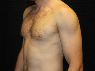 Patient #59775: Gynecomastia Before Image