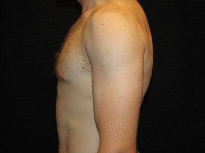 Patient #59775: Gynecomastia After Image