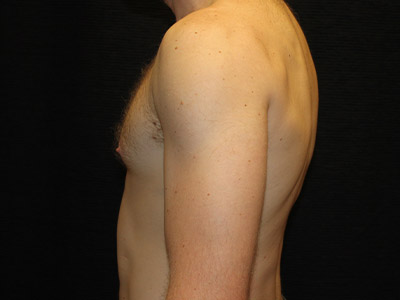 Patient #59775: Gynecomastia Before Image