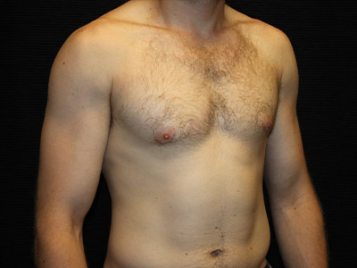 Patient #59775: Gynecomastia After Image
