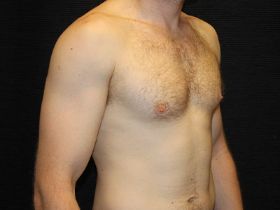 Patient #59775: Gynecomastia Before Image