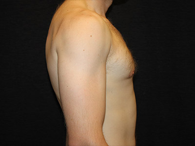 Patient #59775: Gynecomastia After Image