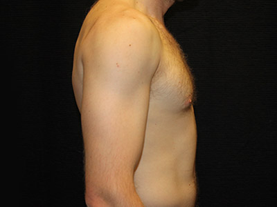 Patient #59775: Gynecomastia Before Image