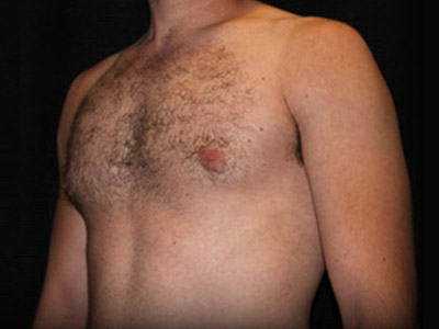Patient #72938: Gynecomastia After Image