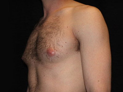 Patient #72938: Gynecomastia Before Image