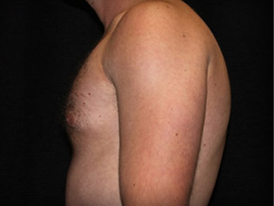 Patient #72938: Gynecomastia After Image