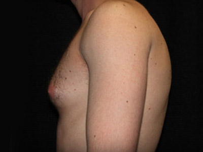 Patient #72938: Gynecomastia Before Image