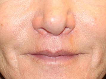 Patient #66479: Lip Lift After Image