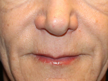 Patient #66479: Lip Lift Before Image
