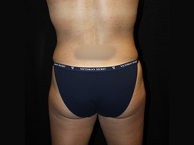 Patient #19316-2: Liposuction of the Back and Legs After Image