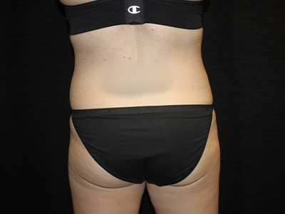 Patient #19316-2: Liposuction of the Back and Legs Before Image