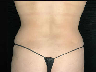 Patient #51918: Liposuction to Flanks After Image