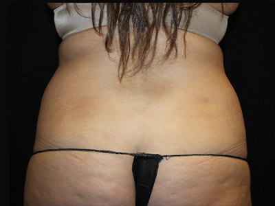 Patient #51918: Liposuction to Flanks Before Image