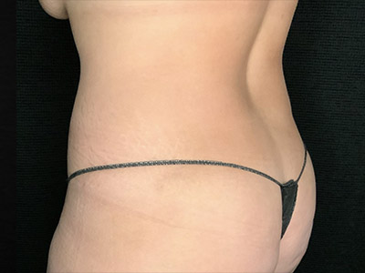 Patient #51918: Liposuction to Flanks After Image