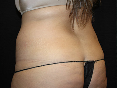 Patient #51918: Liposuction to Flanks Before Image