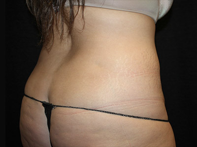 Patient #51918: Liposuction to Flanks Before Image
