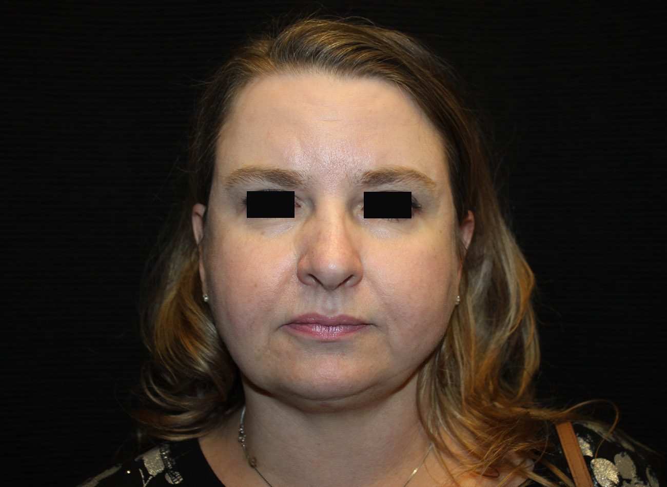 Patient #16939: FaceTite & Morpheus8 After Image