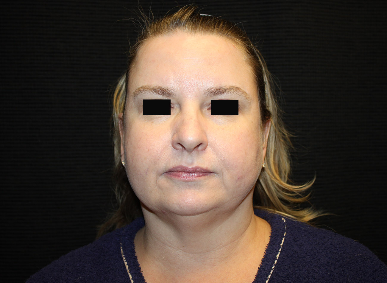 Patient #16939: FaceTite & Morpheus8 Before Image