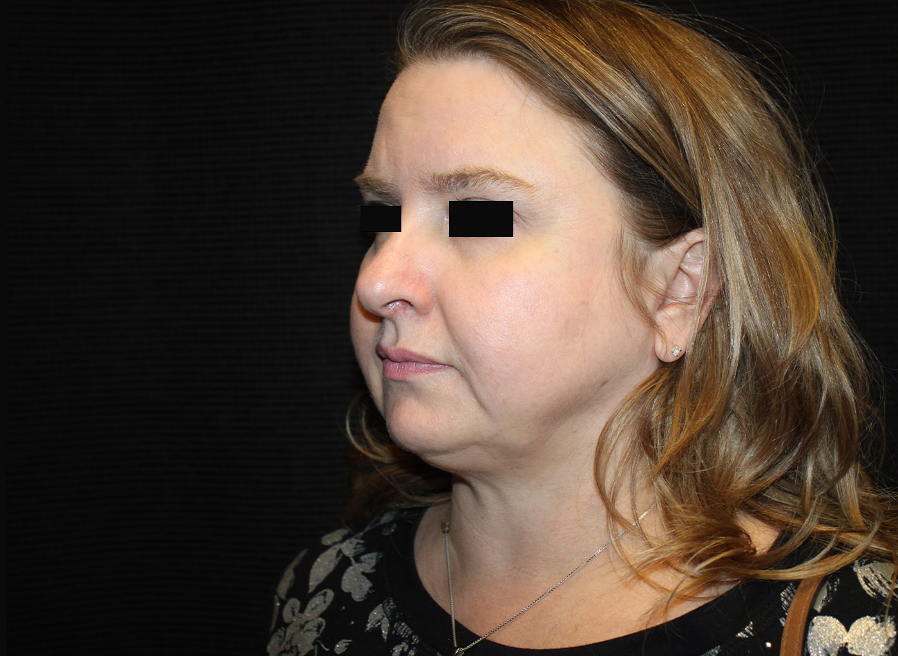 Patient #16939: FaceTite & Morpheus8 After Image