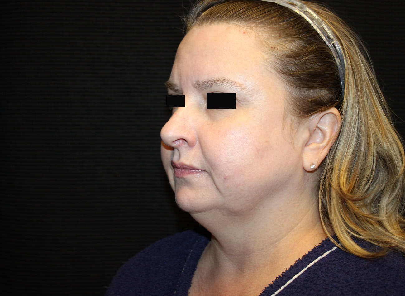 Patient #16939: FaceTite & Morpheus8 Before Image