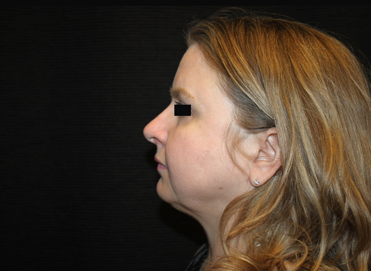 Patient #16939: FaceTite & Morpheus8 After Image