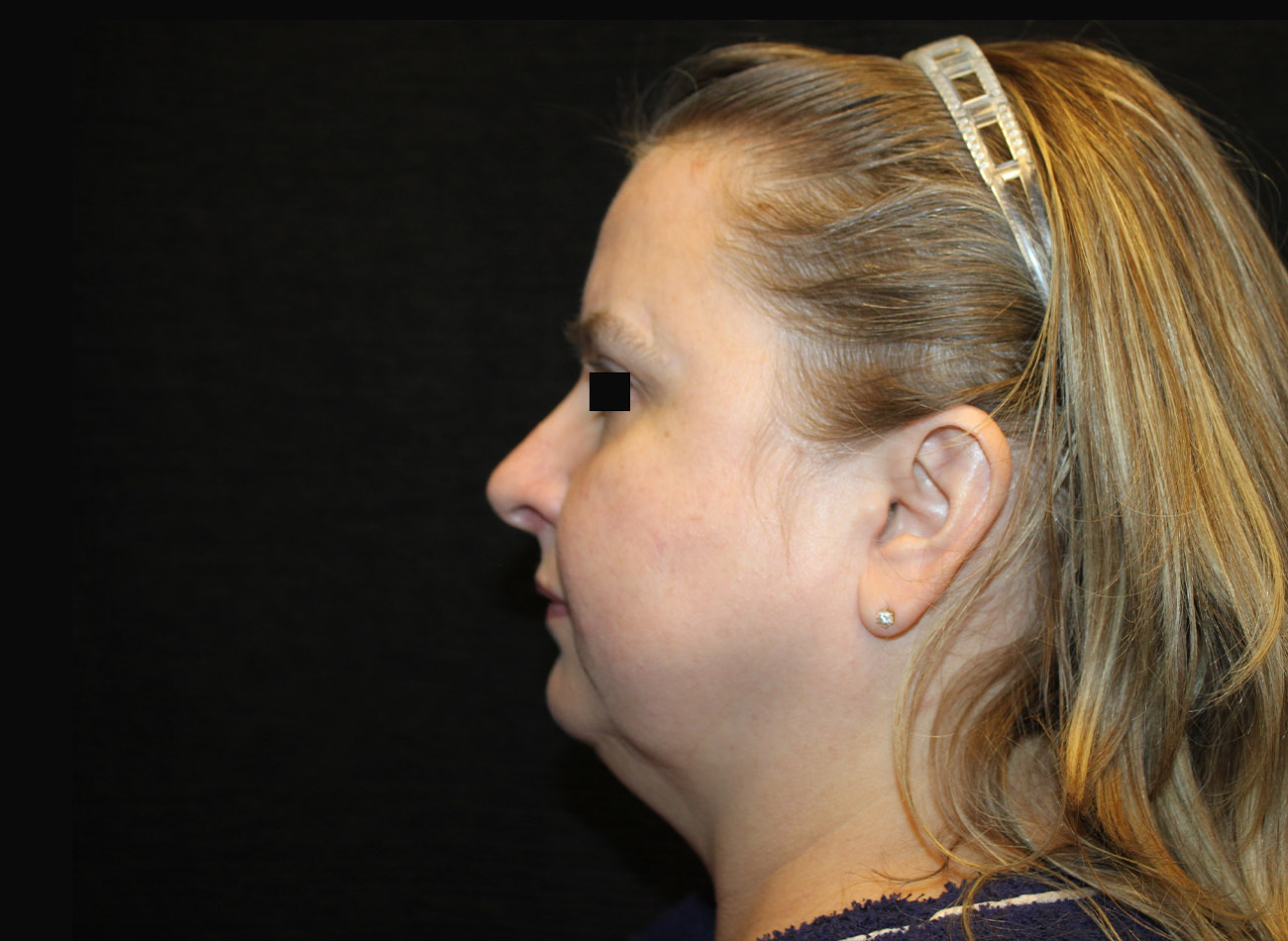 Patient #16939: FaceTite & Morpheus8 Before Image