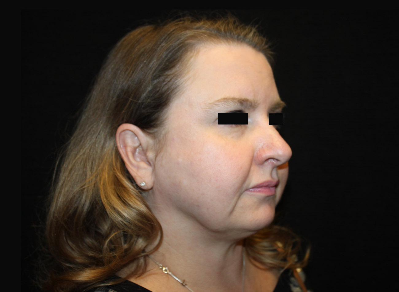 Patient #16939: FaceTite & Morpheus8 After Image