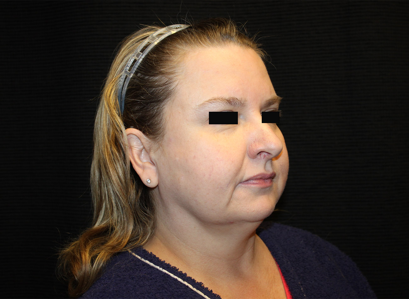Patient #16939: FaceTite & Morpheus8 Before Image