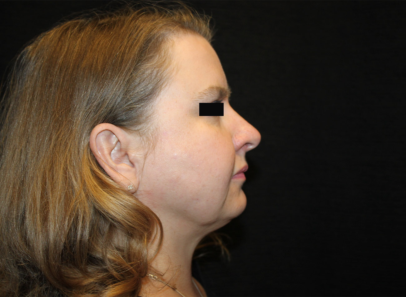Patient #16939: FaceTite & Morpheus8 After Image